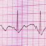 electrocardiogram-300x149