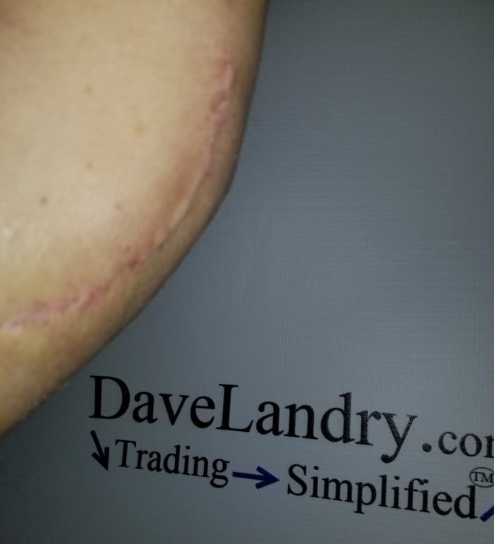 Dave's Scar